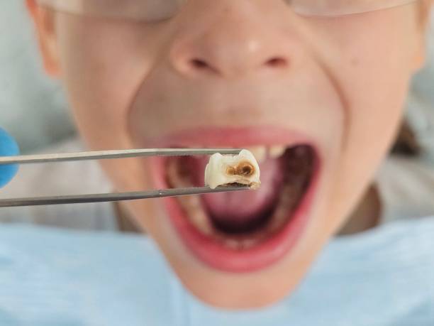 Best Emergency Dentist for Knocked-Out Tooth in Mazomanie, WI